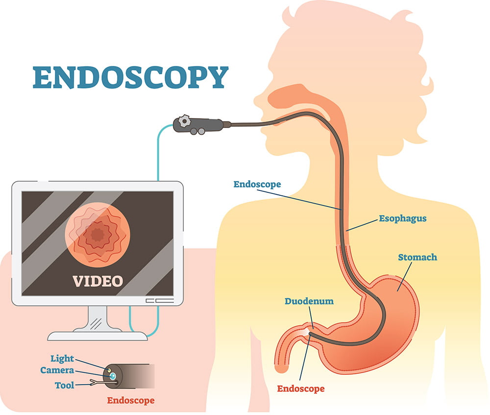 Worthing I Brighton I Sussex | Heartburn | Gastroscopy ...