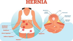 Hernia Surgeon Worthing